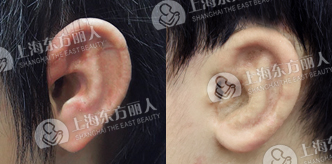 耳垂畸形的3种表现特点