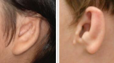 耳甲腔型