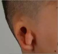 Ⅲ度耳畸形