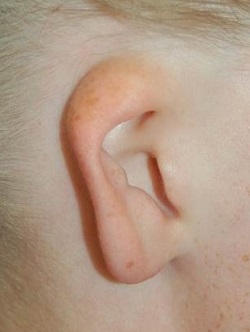 一级耳畸形