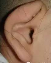 4大杯状耳整形手术