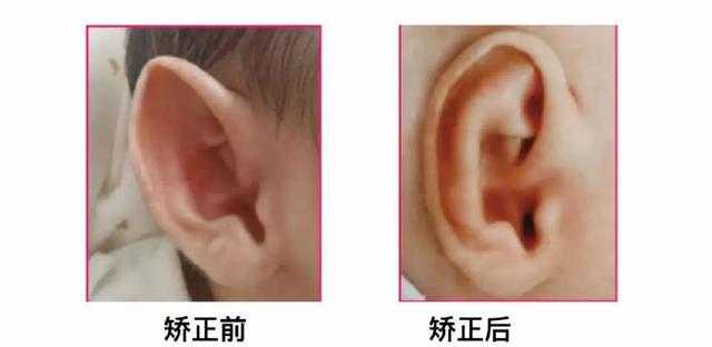 招风耳整形