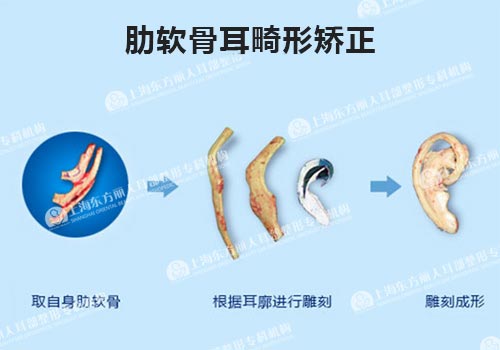 肋软骨