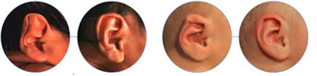 耳廓结构畸形