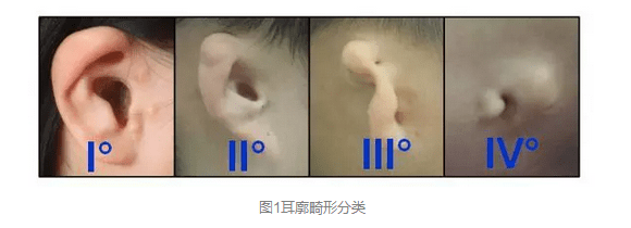耳畸形的程度