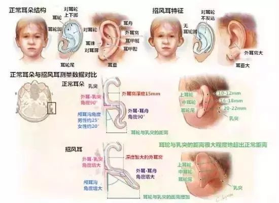 招风耳非“福耳”?不信你进来对照看看