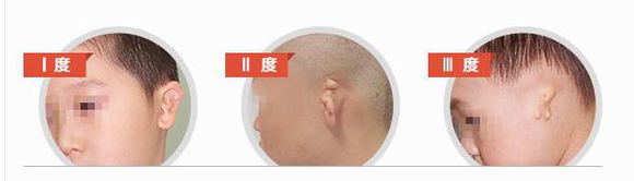 耳畸形三度