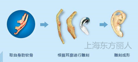 肋软骨