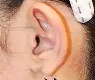 耳垂畸形的几种表现，你知道吗