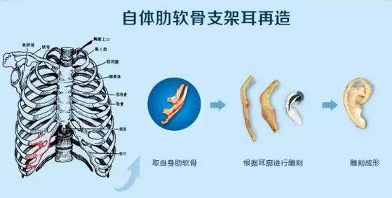 肋软骨
